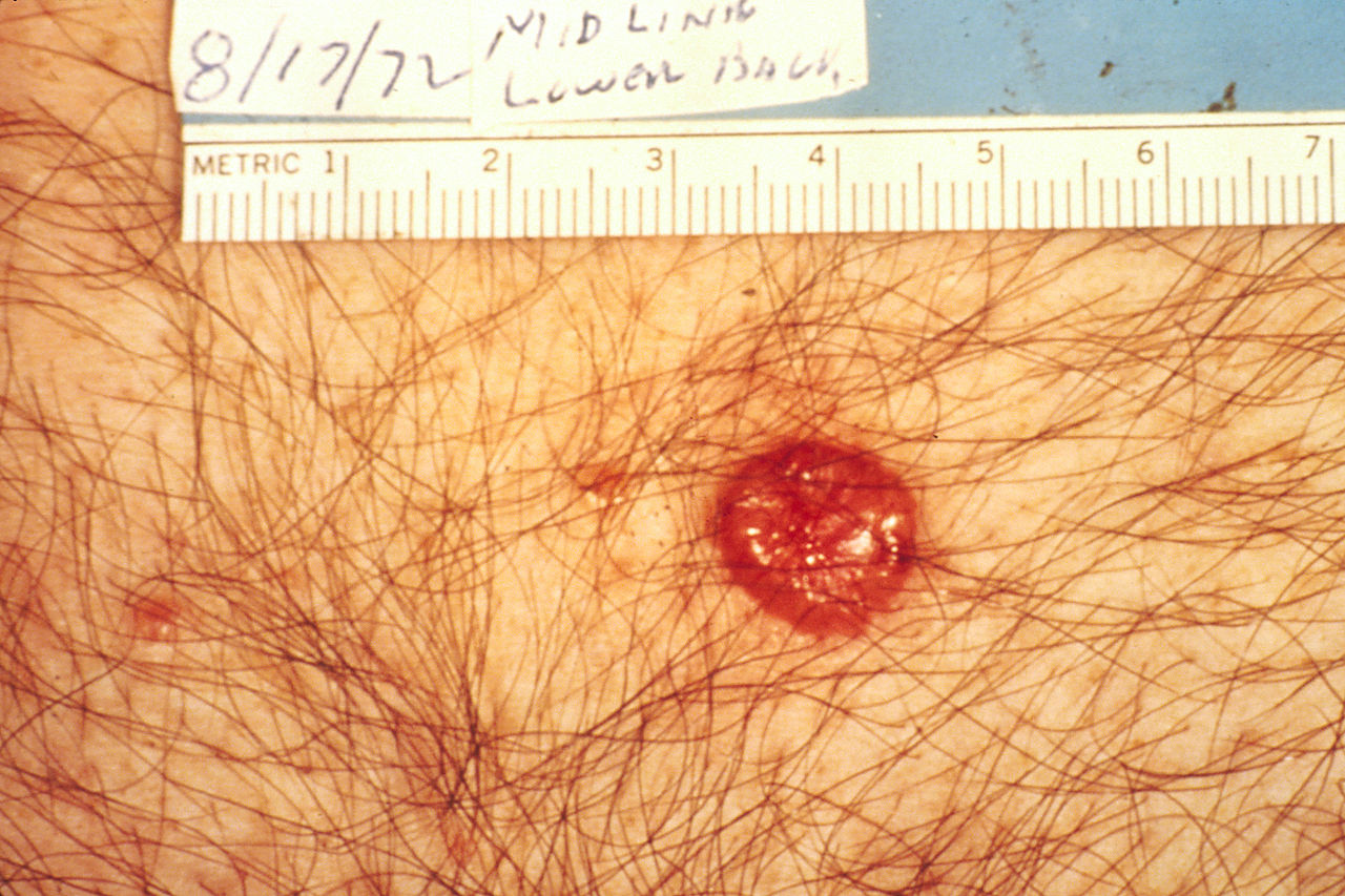 Basal Cell Carcinoma Rolled Edges